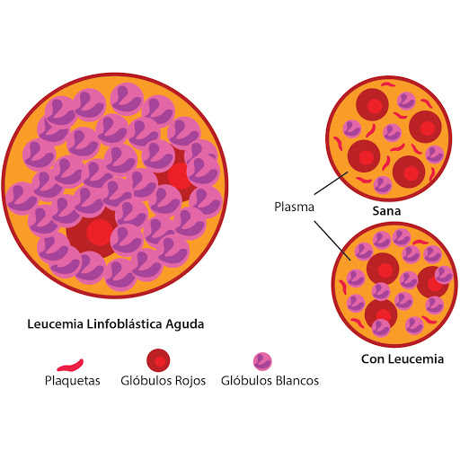 Salud Leucemia En Adultos Bienestar El Popular 2032