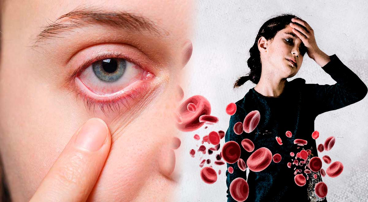Síntomas anemia: cómo reconocerlos, hierro, sangre, | El Popular