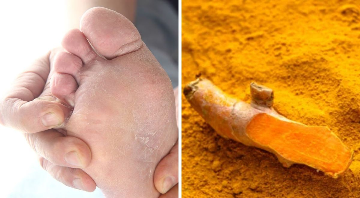 Remedios caseros cómo utiliza la cúrcuma para eliminar los hongos de