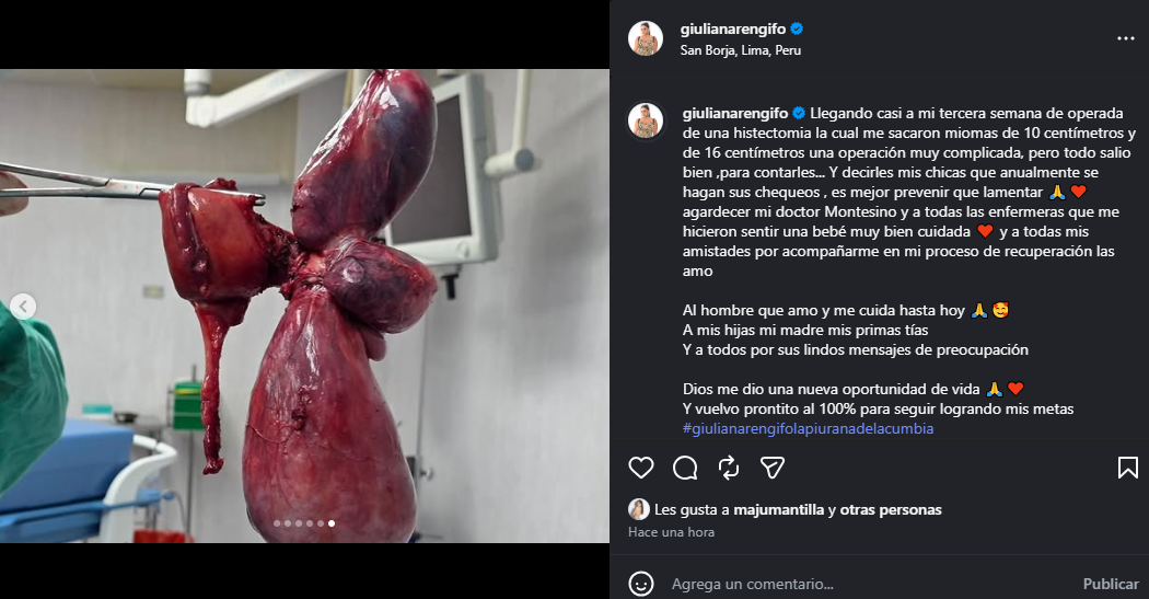 Giuliana Rengifo révèle qu’elle a subi une opération chirurgicale ultra-fine pour retirer son utérus : “Dieu m’a donné une nouvelle chance”